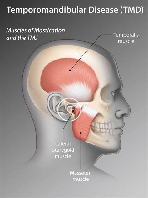 Tmj Temporomandibular Joint Chart Jaw Syndrome