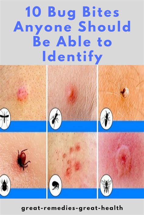 10 Bug Bites Anyone Should Be Able To Identify In 2020 With Images