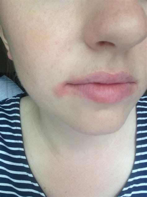 Help Had A Bacterial Infection On My Lip Used Prescription Ointment