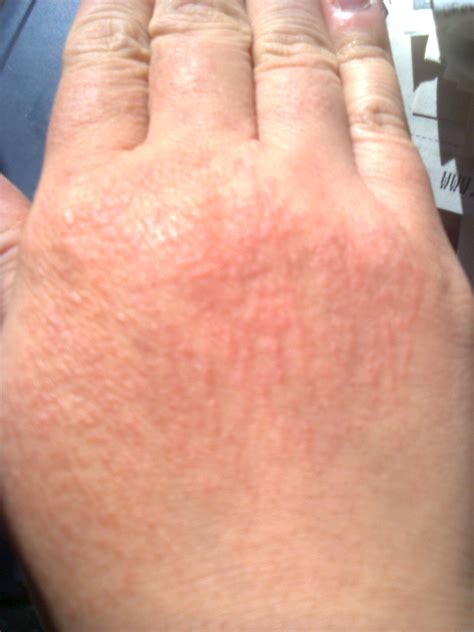 What Causes A Rash On A Child S Hand