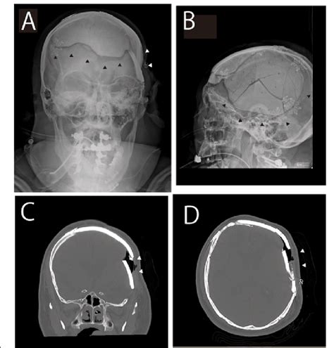 Skull X Ray And Ct Images A Coronal View And B Sagittal View X Ray