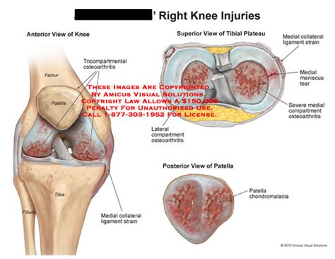 Amicus Illustration Of Amicus Injury Knee Femur Patella Tricompartmental Osteoarthritis Tibia