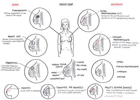 Anatomy of the female breasts. Breast Cancer | Armando Hasudungan
