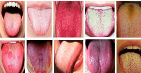 Vea Como La Lengua Puede Ayudar A Identificar Problemas En Su Salud