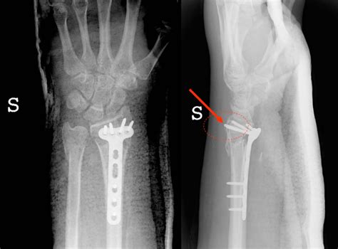 Postoperative X Rays Showing That The Plate Is Too Prominent Volarly At