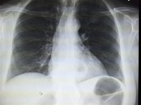 Subsegmetal Atelectasis On Chest X Ray Radiology In Plain English