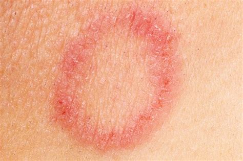 Skin Rashes That Look Like Ringworm