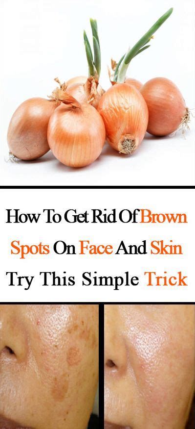 How To Get Rid Of Brown Spots On Face And Skin Try This Simple Trick