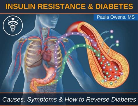 Insulin Resistance Pre Diabetes And Diabetes Paula Owens Ms