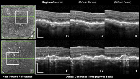 Oct Signs Of Early Atrophy In Age Related Macular Degeneration