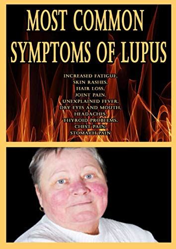 Most Common Symptoms Of Lupus Increased Fatigue Skin Rashes Hair