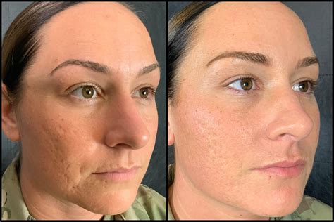 Microneedling Before And After 05 Bella Vi