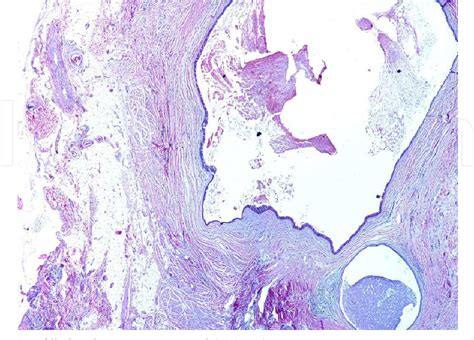 Figure 2 From Mucous Cysts As A Complication Of Rhinoplasty Semantic