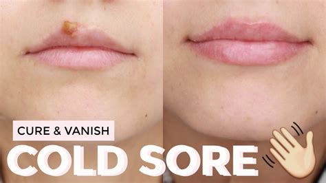 How To Cure A Cold Sore Fast Healed And Scab Free Youtube