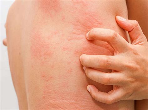 Hives Symptoms Of Hives