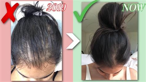 How I Grew My Hair Back Naturally Qanda Before And Afters Hair Loss Story Results In Just 1