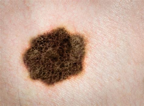 Skin As Related To Melanoma Pictures