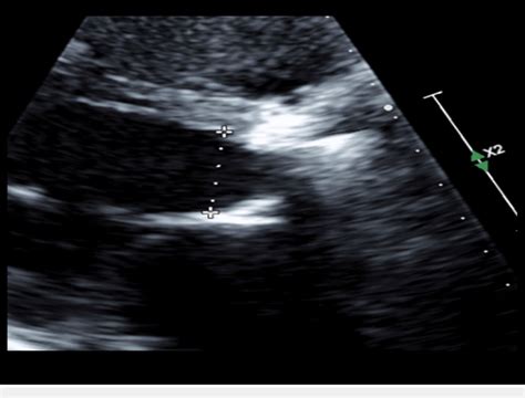 Echocardiogram Showing Ball And Cage And Starr Edwards Valve