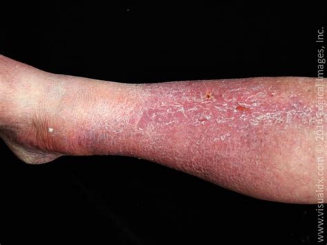 Cellulitis Skin Infection Causes And How Do To Treat