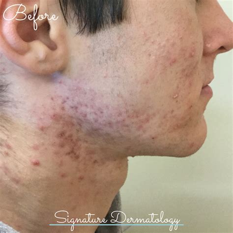 Acne Treatment Before And After Signature Dermatology