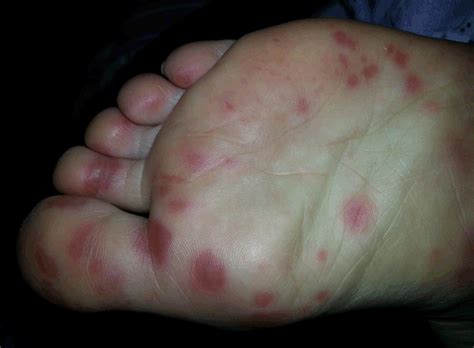 Hand Foot Mouth Disease Pictures Adults