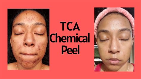 Chemical Peel Experience 25 Tca Peelbefore And After Pictures