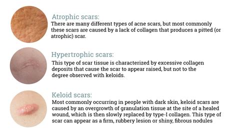 What Can You Do About Acne Scarring Art Of Dermatology New York