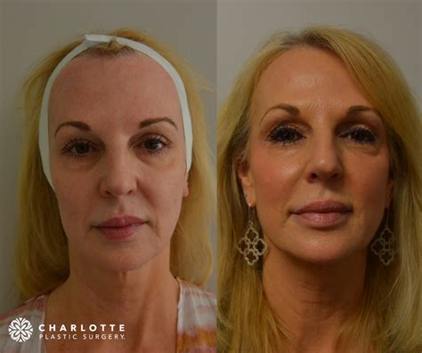 Thread Lift Vs Facelift Put Your Best Face Forward