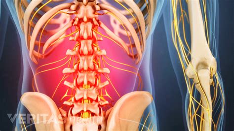 Stress Related Back Pain