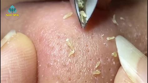 Best Satisfying Nose Plucking Blackheads Whiteheads Removal Acne
