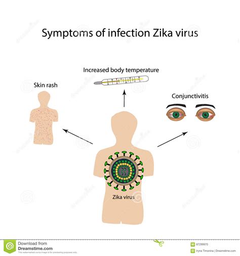 Zika Virus Symptome Der Infektion Infographics Auch Im Corel Abgehobenen Betrag Vektor Abbildung
