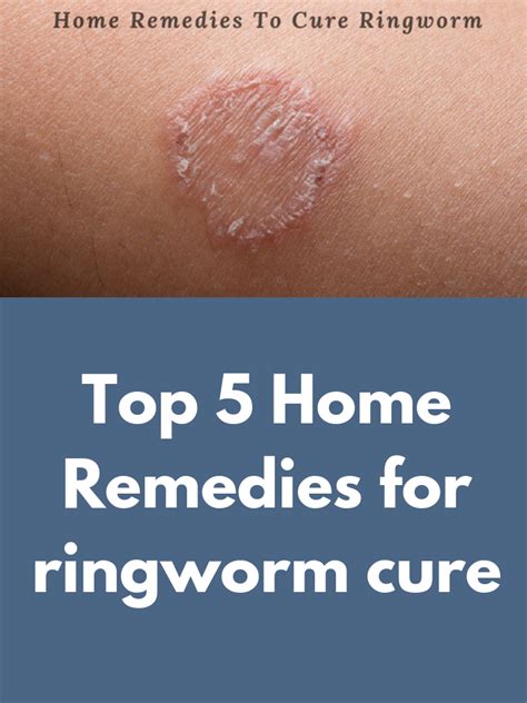 Ringworm Rash On Face Treatment