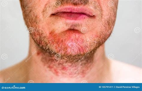 Man With Seborrheic Dermatitis In The Beard Area Stock Image Image Of