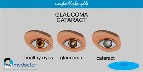 Cataract Vs Glaucoma My Doctor