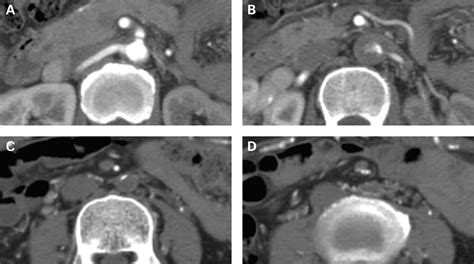 Three Dimensional Ct Images Of High Aortic Occlusion Associated With