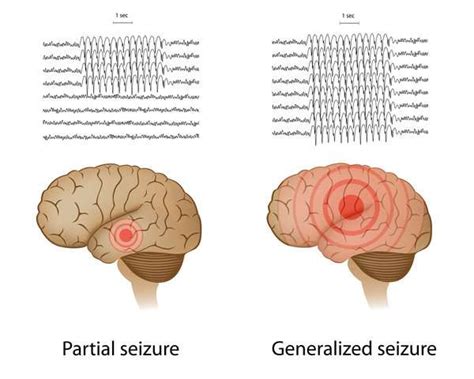 Epileptic Seizures And Depression May Share A Common Genetic Cause