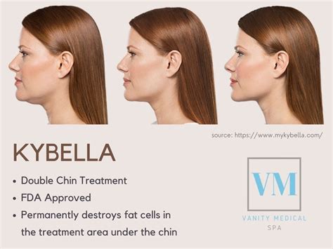 Kybella Double Chin Treatment Fda Approved Call Vanity Medical Spa Now