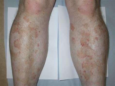 Read on to learn about the three stages of sepsis and how to identify the symptoms. July case of the month - gain CPD points | Primary Care ...