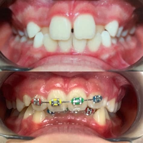 Orthodontic Treatment Braces For Adults And Kids Firouz Orthodontics
