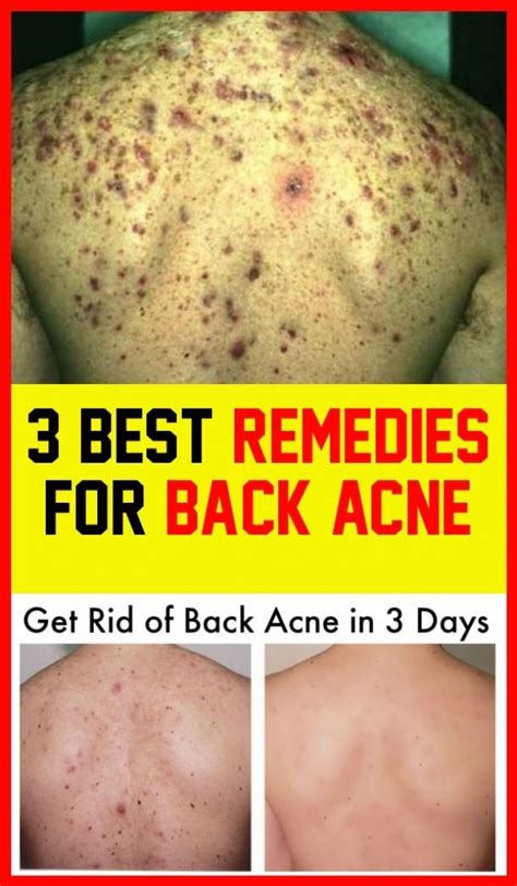 3 Back Acne Best Remedies In 2020 Back Acne Remedies Best Acne
