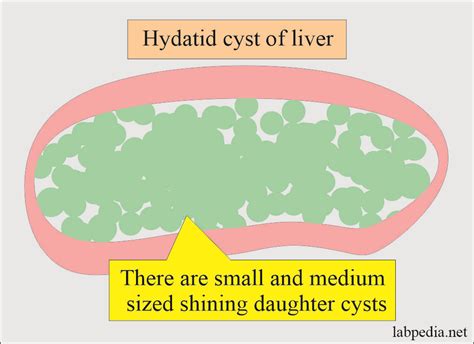 Echinococcus Granulosus Hydatid Cyst And Hydatid Disease
