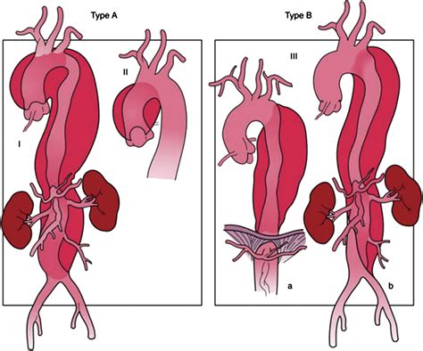 Acute Aortic Dissection In The Emergency Department Diagnostic