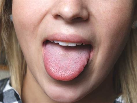 Sore Tongue Possible Causes Healthline