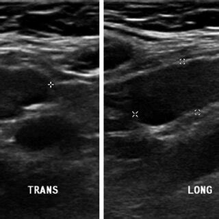 A Year Old Female S Transverse And Longitudinal Ultrasound Presents Download Scientific