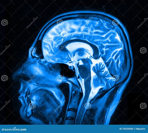 Magnetic Resonance Imaging Of The Brain Stock Image Image Of Human
