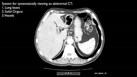 A ct scan of the abdomen can provide critical information related to injury or disease of organs. How to interpret an abdominal CT - YouTube