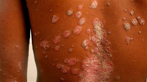 Hiv Skin Rash Symptoms