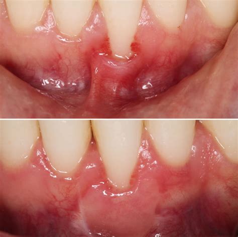 Gingival Recession Of Lower Incisor Case Study Australian Dental