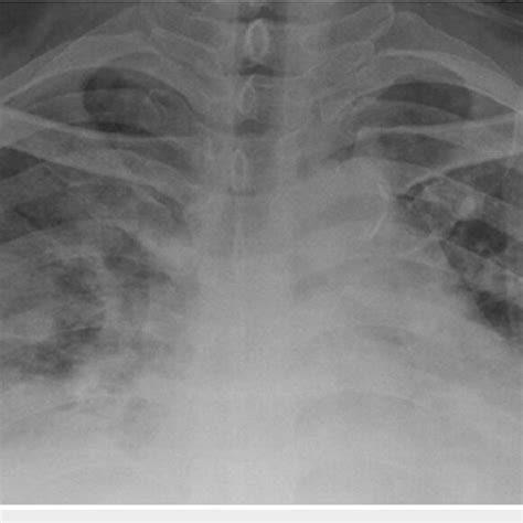 Chest X Ray Showing Bilateral Blunted Costophrenic Angles With