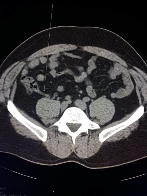 Ct Scan Of The Abdomen And Pelvis Shows A Normal Appendix